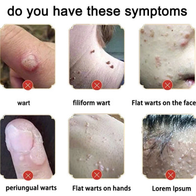 Kem Mụn Cóc, Mụn Thịt, Mụn Cơm Hiệu Quả – Chiết Xuất Thảo Dược An Toàn 20g, ĐÈN TRANG TRÍ , ĐỒNG HỒ TREO TƯỜNG