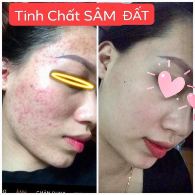 Tinh Chất Sâm Đất DR CELL 50ml tái tạo da, triệt tiêu mụn, mờ thâm nám, thu nhỏ chân lông