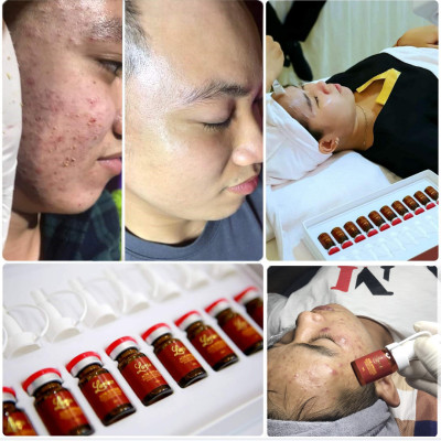 Tế bào gốc DNA cá hồi xóa sạch mụn,mờ thâm do mụn 8ml (LARIAN ACNE AMPOULE)